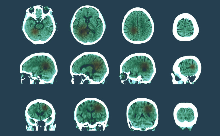 AI and Medical Imaging: Transforming Diagnosis & Care